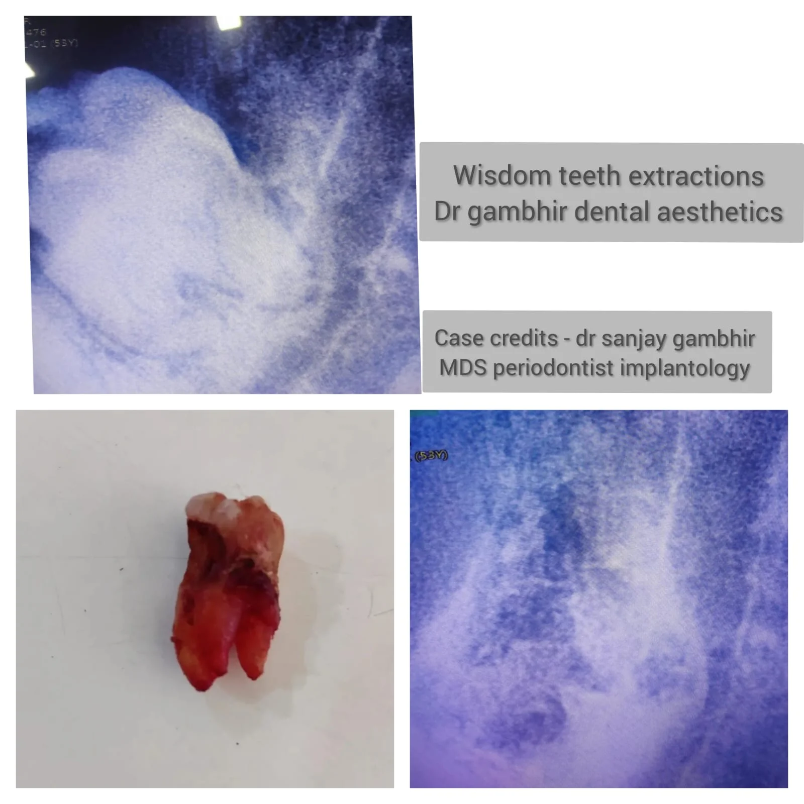 Wisdom Teeth Extraction